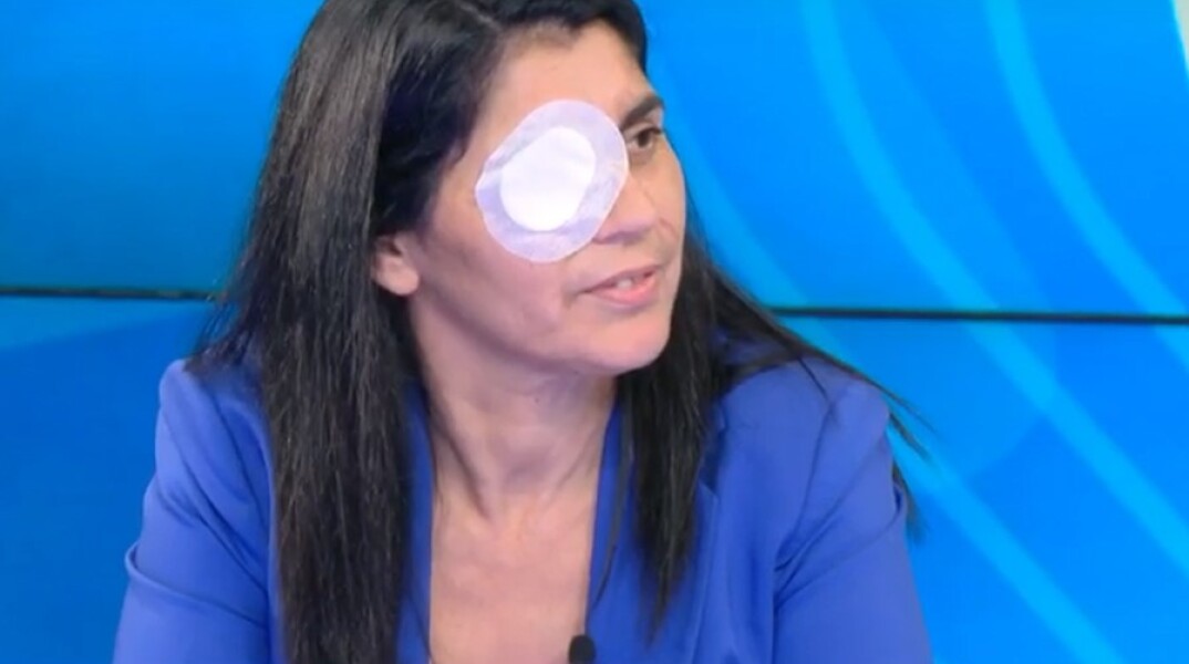 Η 49χρονη Χριστίνα, θύμα της επίθεσης με οξύ στη Μεσσήνη, με καλυμμένο το ένα της μάτι